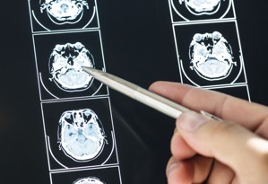 Closeup of brain mri scan result 2022 09 16 08 08 02 utc  1