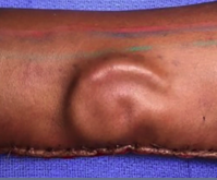 Army Doctors Grew a Soldier a New Ear On Her Forearm Time