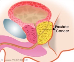 Prostate cancer treatment